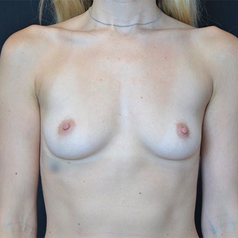 Breast Augmentation Before & After Gallery - Patient 114721109 - Image 1