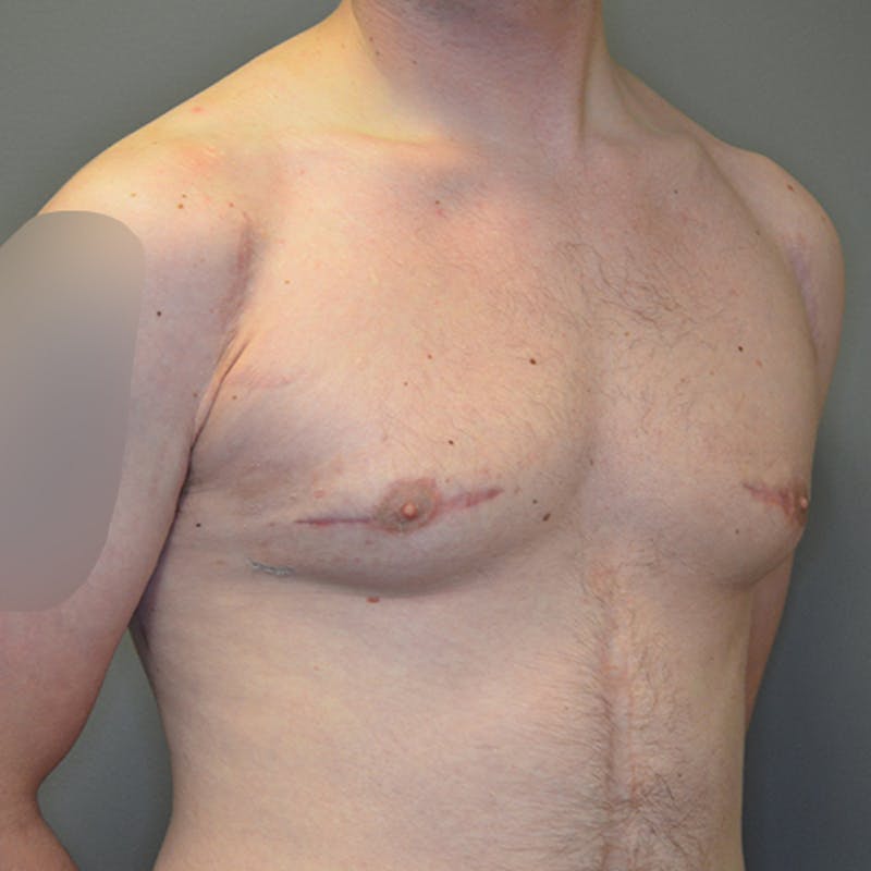 Gynecomastia Before & After Gallery - Patient 114721107 - Image 4