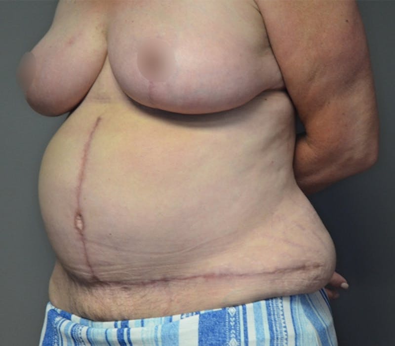 Fleur de lis Abdominoplasty Before & After Gallery - Patient 114721103 - Image 6