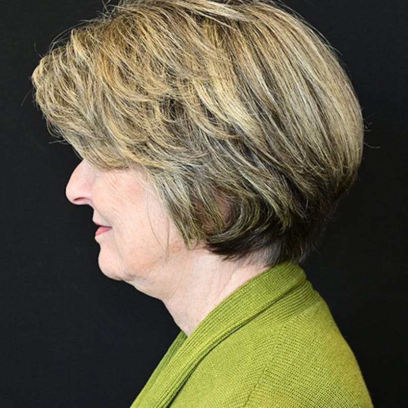 Neck Lift Before & After Gallery - Patient 114721111 - Image 1