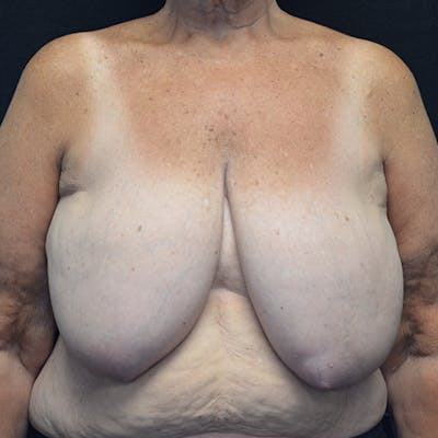 Breast Reconstruction Before & After Gallery - Patient 114721112 - Image 1