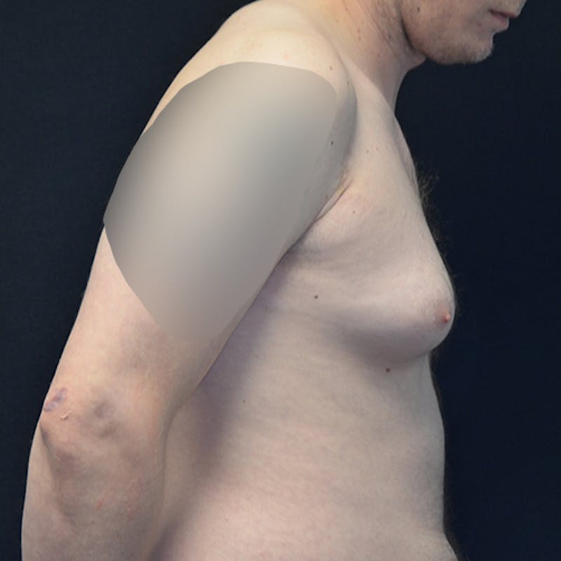 Gynecomastia Before & After Gallery - Patient 118184866 - Image 5