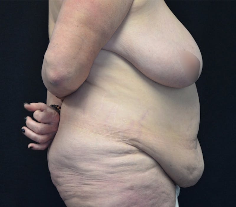 Fleur de lis Abdominoplasty Before & After Gallery - Patient 114721103 - Image 7