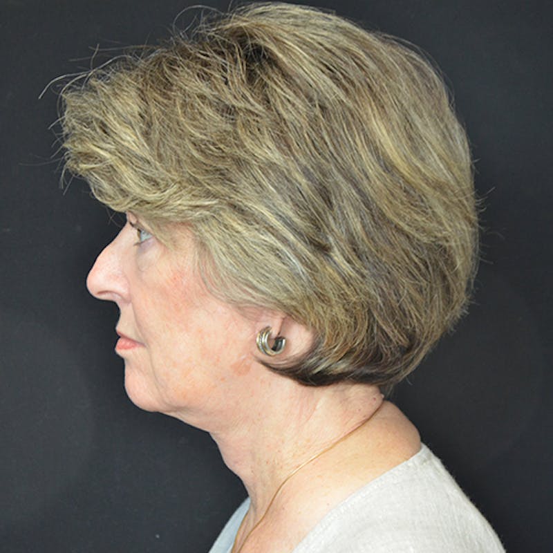 Neck Lift Before & After Gallery - Patient 114721111 - Image 2