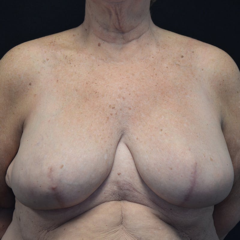 Breast Reconstruction Before & After Gallery - Patient 114721112 - Image 2