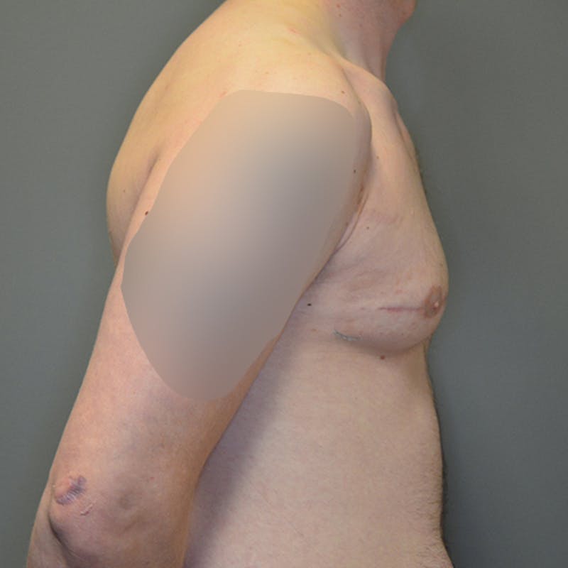 Gynecomastia Before & After Gallery - Patient 114721107 - Image 6
