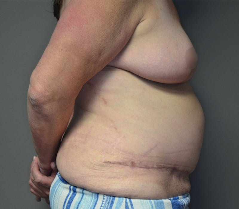 Fleur de lis Abdominoplasty Before & After Gallery - Patient 114721103 - Image 8