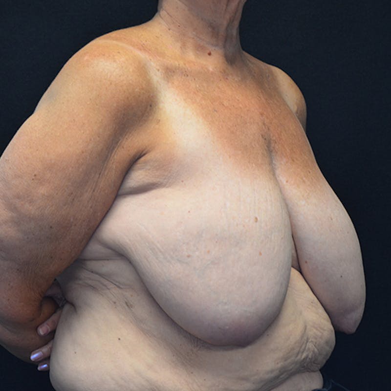 Breast Reconstruction Before & After Gallery - Patient 114721112 - Image 3