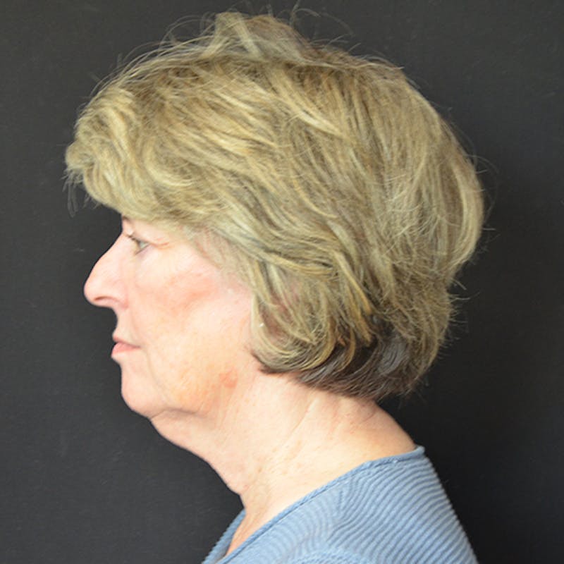 Neck Lift Before & After Gallery - Patient 114721111 - Image 3
