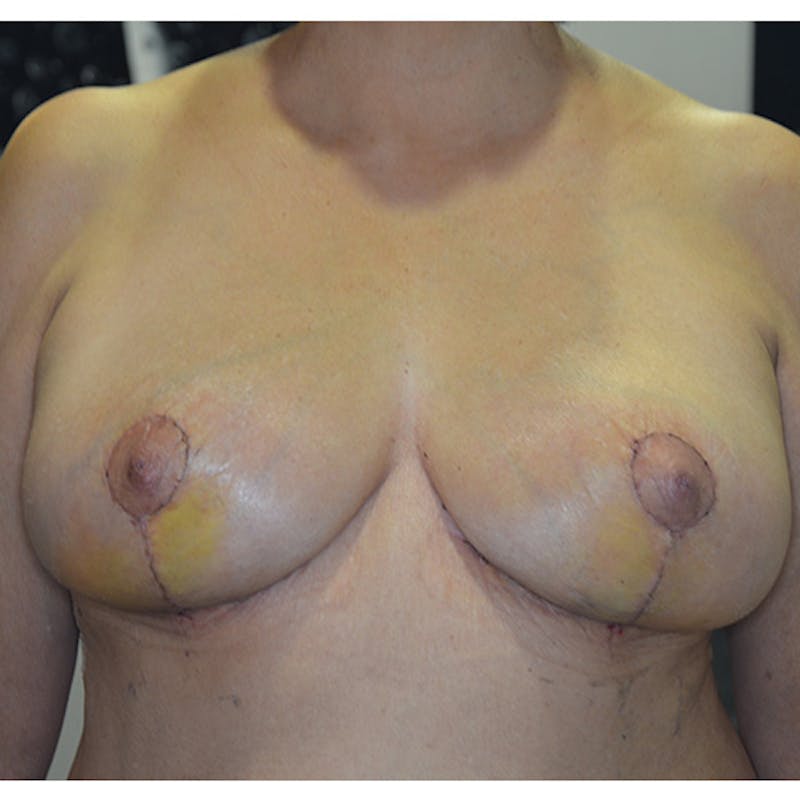 Breast Reduction Before & After Gallery - Patient 114721106 - Image 2