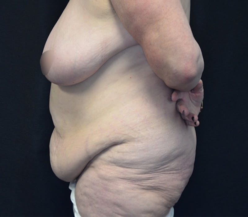 Fleur de lis Abdominoplasty Before & After Gallery - Patient 114721103 - Image 9