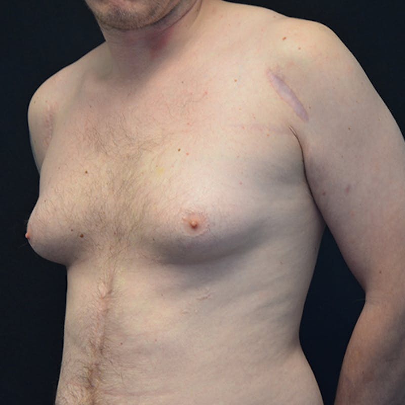 Gynecomastia Before & After Gallery - Patient 114721107 - Image 7