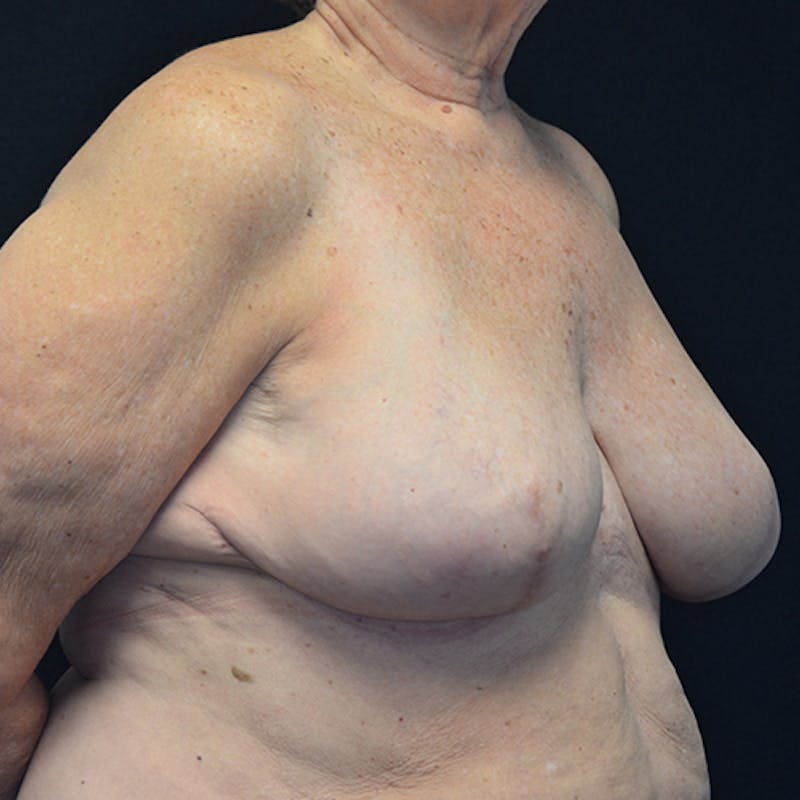 Breast Reconstruction Before & After Gallery - Patient 114721112 - Image 4