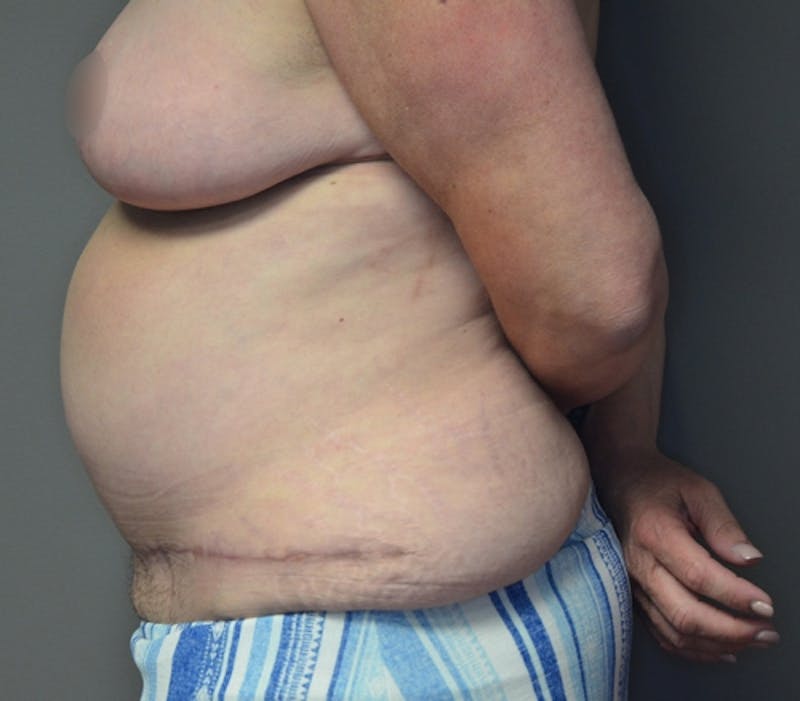 Fleur de lis Abdominoplasty Before & After Gallery - Patient 114721103 - Image 10