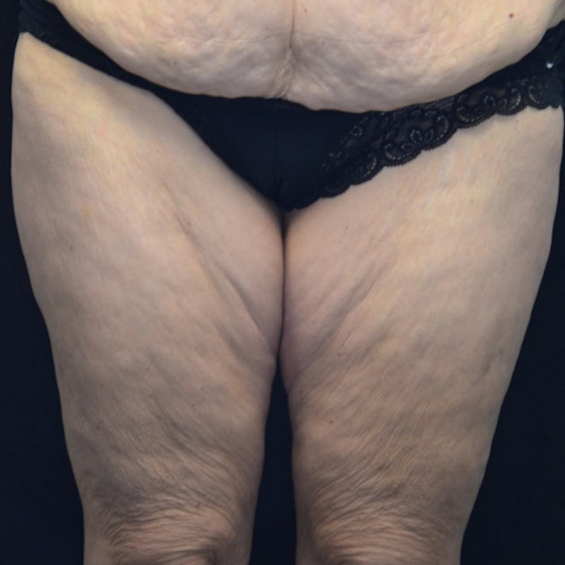 Thigh Lift Before & After Gallery - Patient 114721105 - Image 1