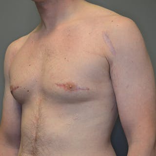 Gynecomastia Before & After Gallery - Patient 133543 - Image 8
