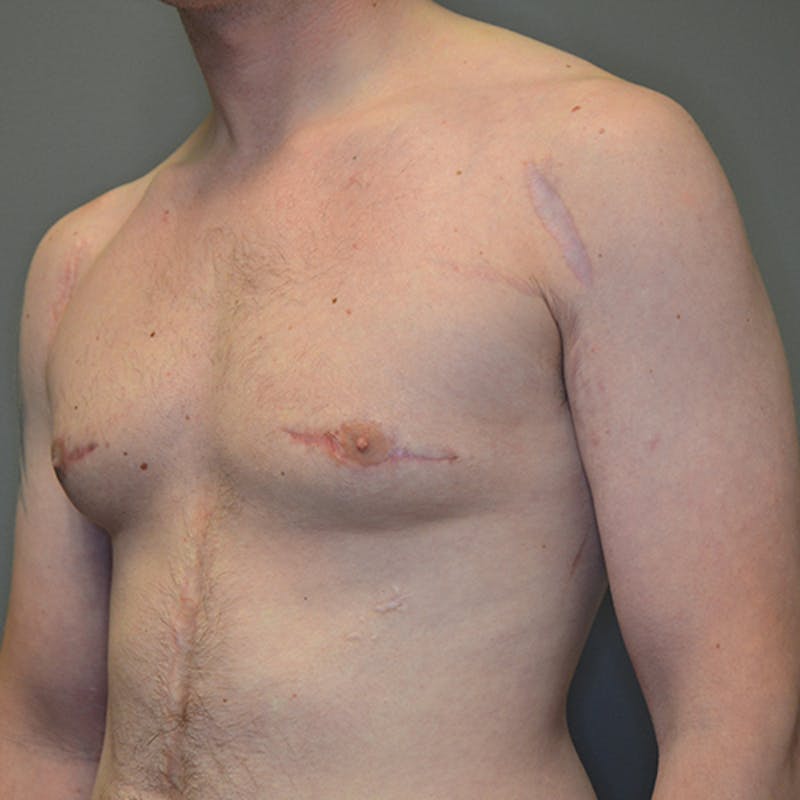 Gynecomastia Before & After Gallery - Patient 118184866 - Image 8