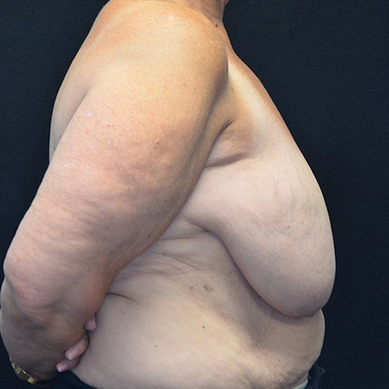 Breast Reconstruction Before & After Gallery - Patient 114721112 - Image 5