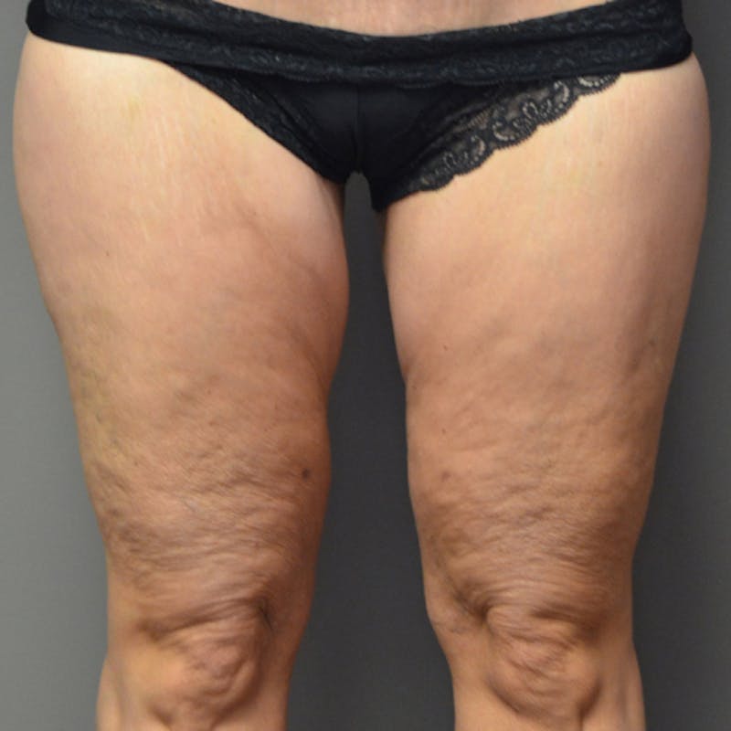 Thigh Lift Before & After Gallery - Patient 114721105 - Image 2