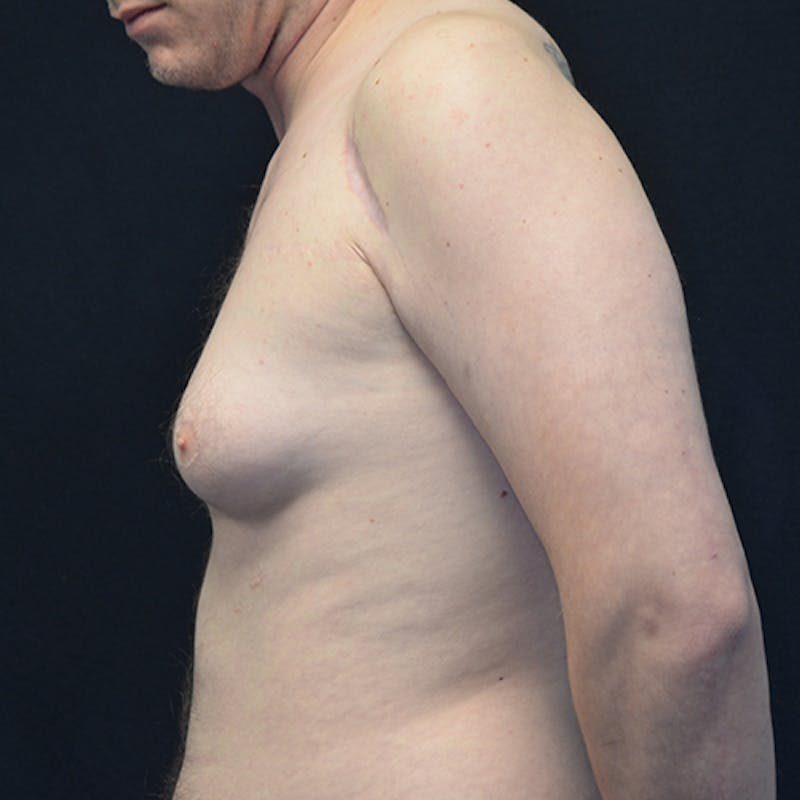 Gynecomastia Before & After Gallery - Patient 114721107 - Image 9