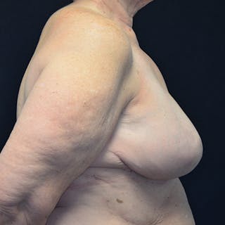 Breast Reconstruction Before & After Gallery - Patient 114721112 - Image 6