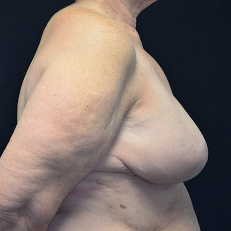 Breast Reconstruction Before & After Gallery - Patient 114721112 - Image 6