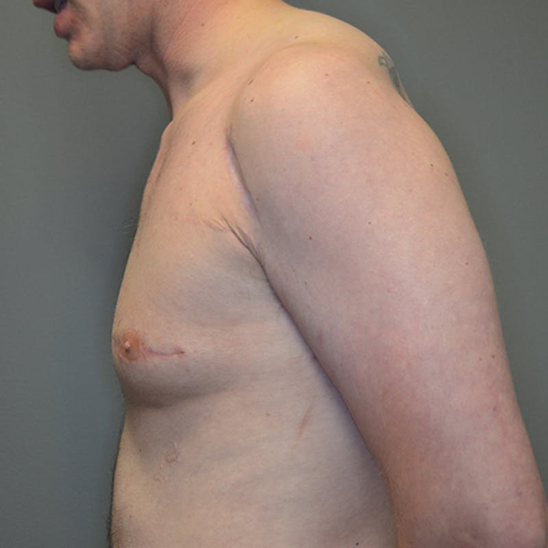 Gynecomastia Before & After Gallery - Patient 114721107 - Image 10