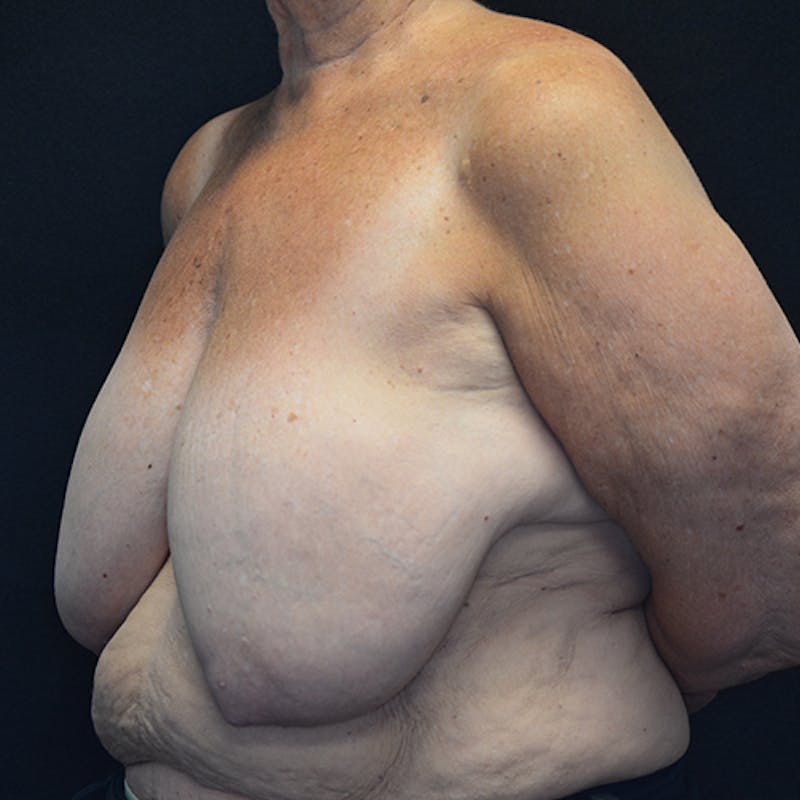 Breast Reconstruction Before & After Gallery - Patient 114721112 - Image 7