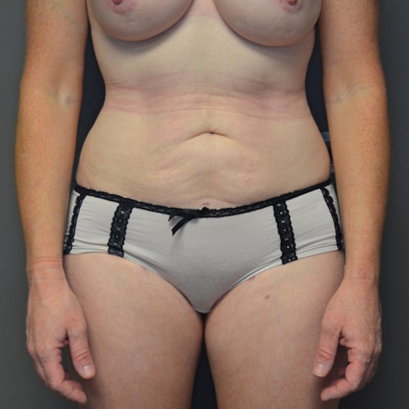 Liposuction Before & After Gallery - Patient 114721108 - Image 2