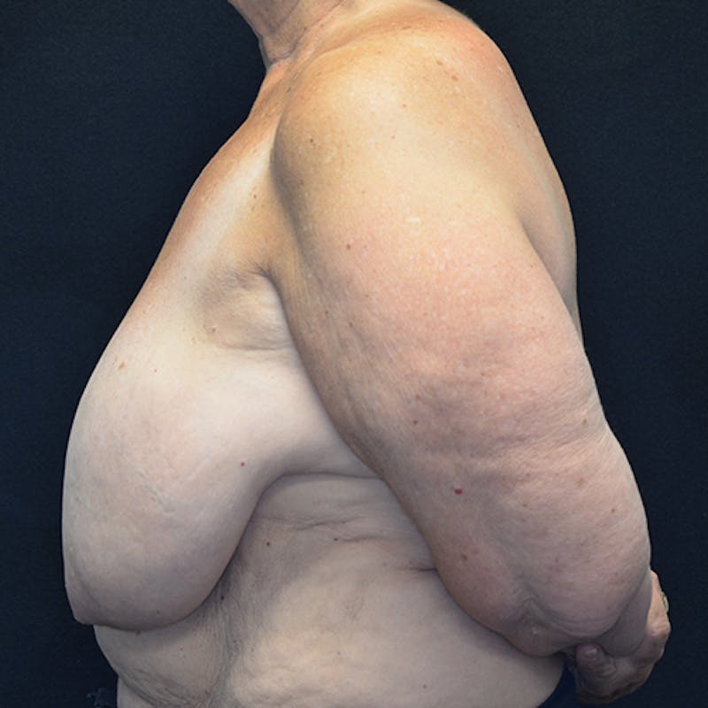 Breast Reconstruction Before & After Gallery - Patient 114721112 - Image 9