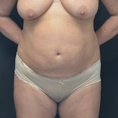 Liposuction Before & After Gallery - Patient 114721121 - Image 1