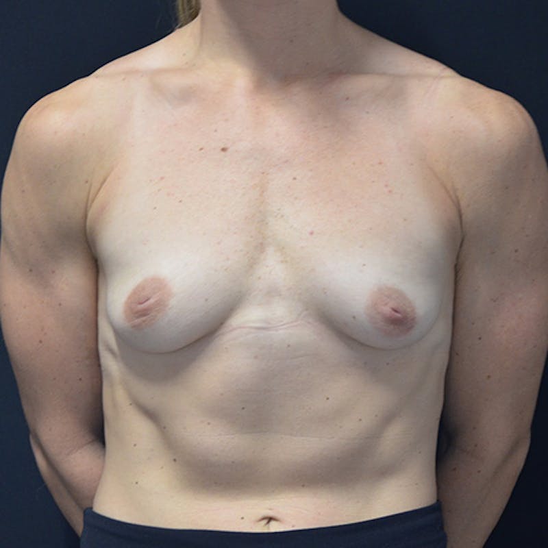 Breast Augmentation Before & After Gallery - Patient 114721117 - Image 1