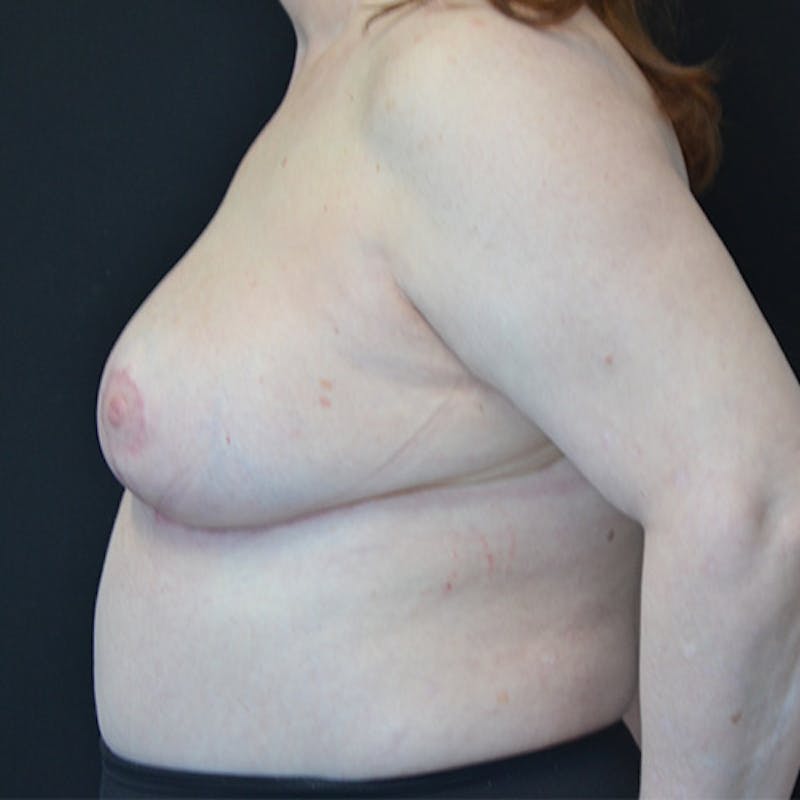 Breast Reduction Before & After Gallery - Patient 114721116 - Image 4