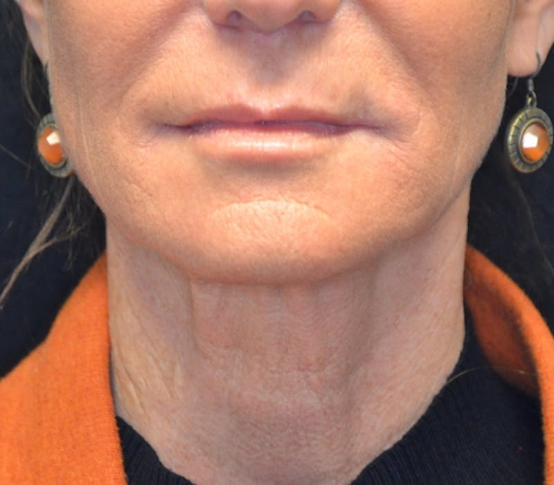 Neck Lift Before & After Gallery - Patient 114721120 - Image 6