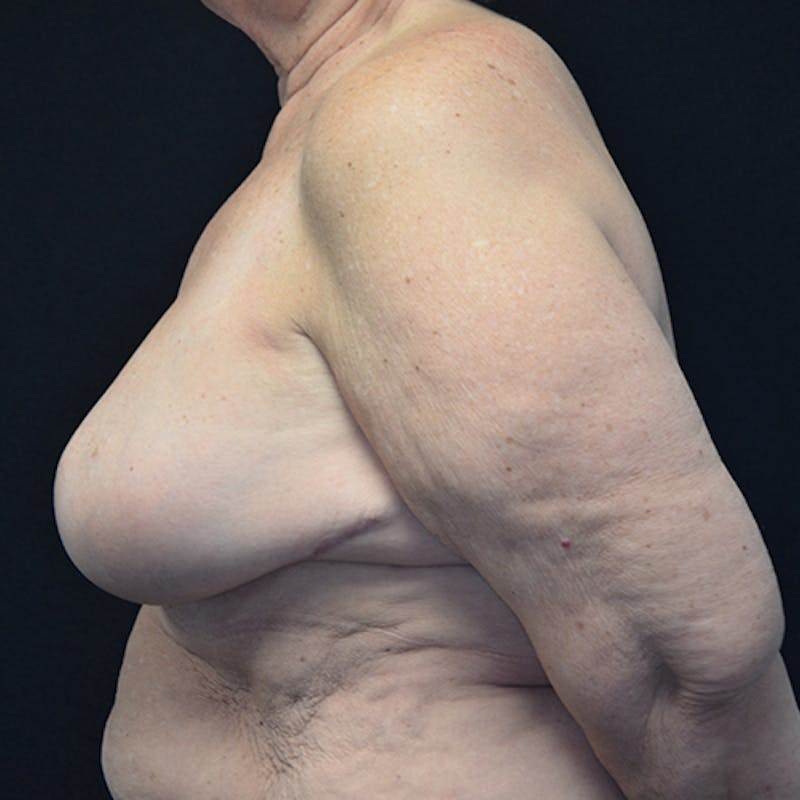 Breast Reconstruction Before & After Gallery - Patient 114721112 - Image 10