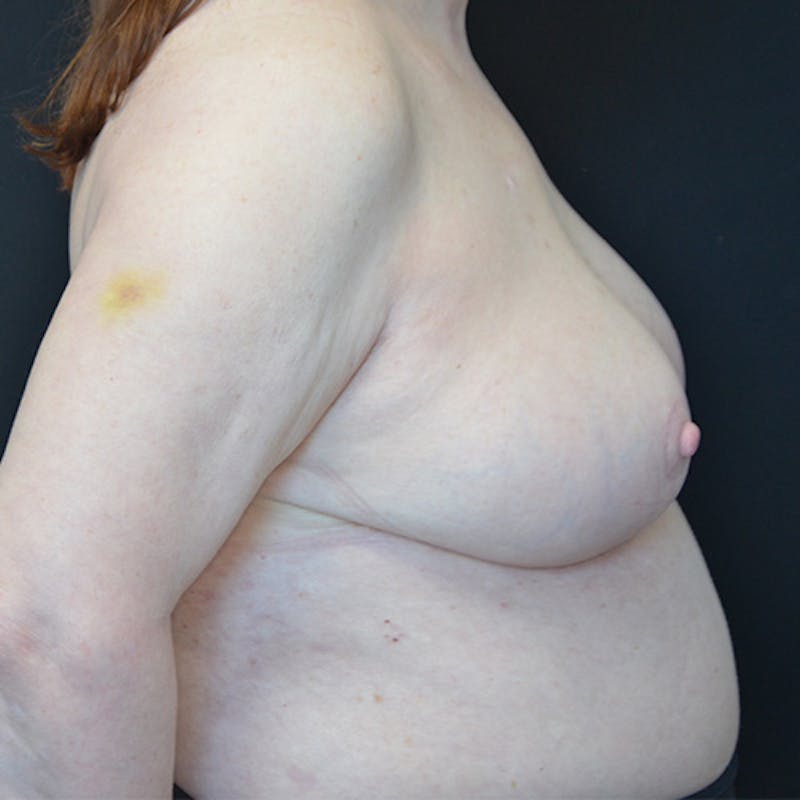 Breast Reduction Before & After Gallery - Patient 114721116 - Image 6