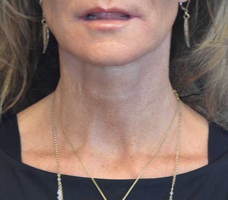 Neck Lift Before & After Gallery - Patient 114721120 - Image 5