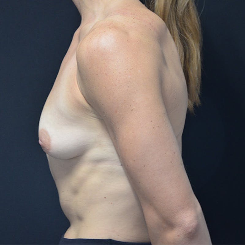 Breast Augmentation Before & After Gallery - Patient 114721117 - Image 3