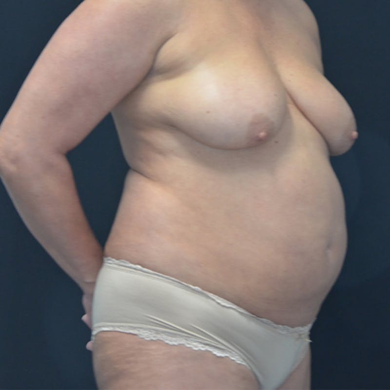 Liposuction Before & After Gallery - Patient 114721121 - Image 3