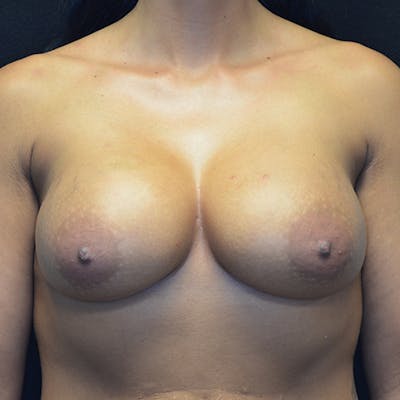 Breast Reconstruction Before & After Gallery - Patient 114721125 - Image 1
