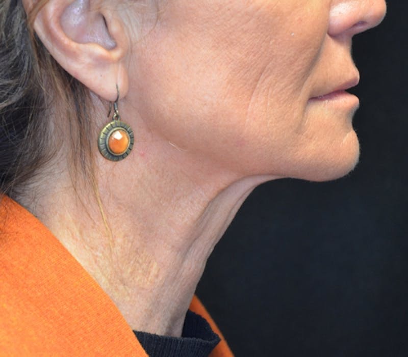 Neck Lift Before & After Gallery - Patient 114721120 - Image 10