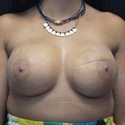 Breast Reconstruction Before & After Gallery - Patient 114721125 - Image 2