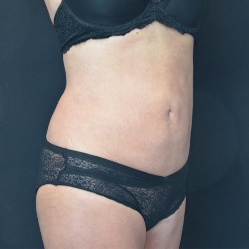 Liposuction Before & After Gallery - Patient 114721121 - Image 4