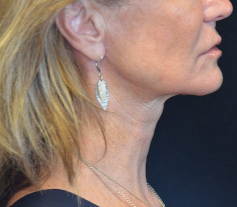 Neck Lift Before & After Gallery - Patient 114721120 - Image 9