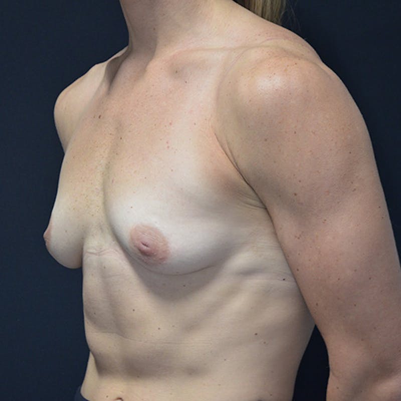 Breast Augmentation Before & After Gallery - Patient 114721117 - Image 5