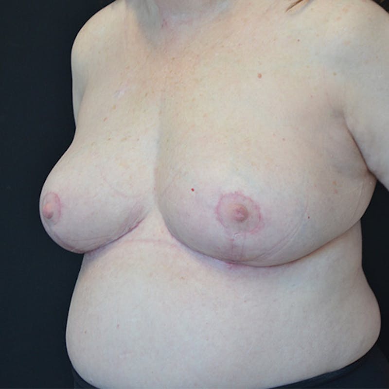 Breast Reduction Before & After Gallery - Patient 114721116 - Image 8