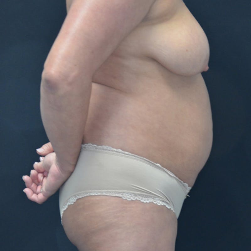 Liposuction Before & After Gallery - Patient 114721121 - Image 5