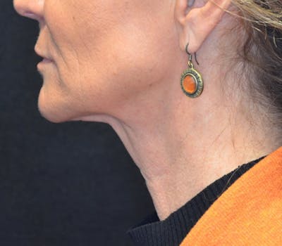Neck Lift Before & After Gallery - Patient 114721120 - Image 2