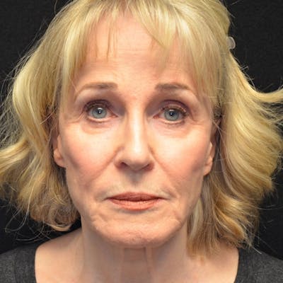 Facelift Before & After Gallery - Patient 114721126 - Image 1