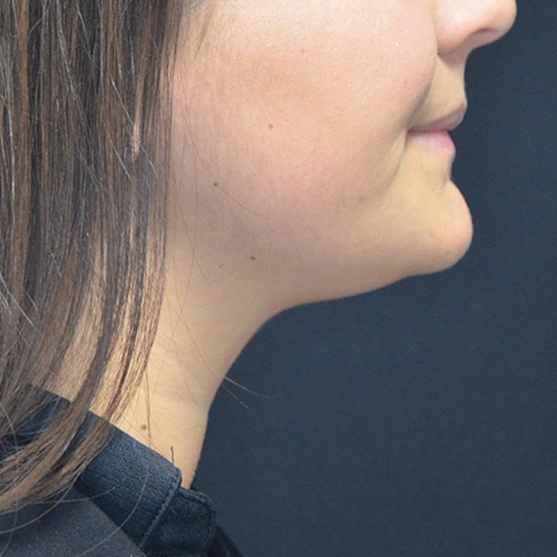 Dermal Fillers Before & After Gallery - Patient 114721114 - Image 1